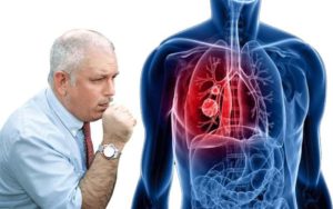 Tuberculosis Symptoms in Men