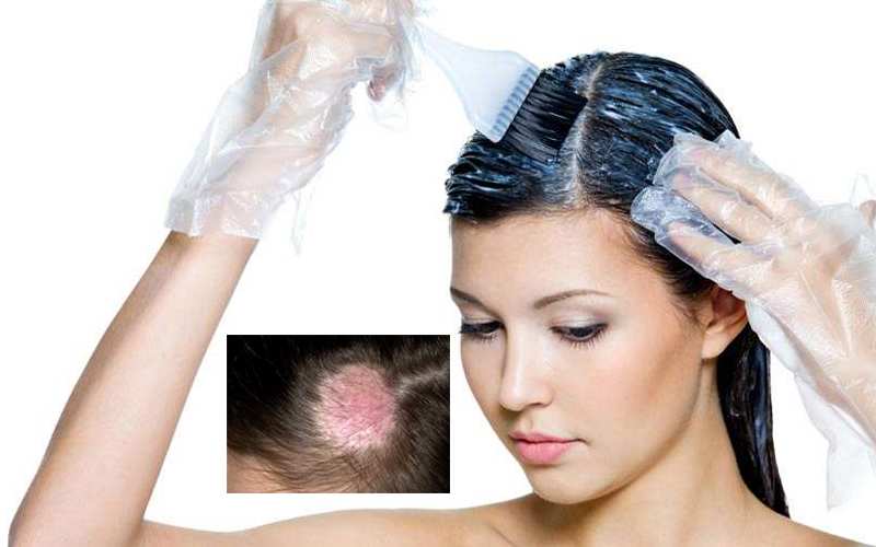 Remedies for Skin Allergy Due to Hair Dye