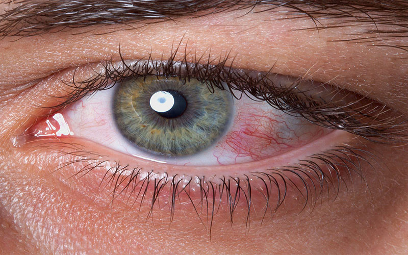 Dry Eye Syndrome Parenting Children Eye Study