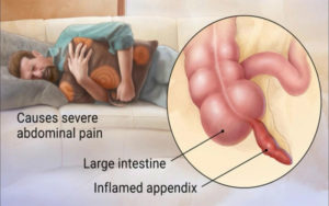 Appendicitis may be treated with Antibiotics without Surgery