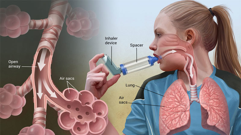 What can cause Asthma Triggers?