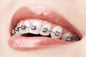 Should You Consider Wearing Retainers After Orthodontic Treatment