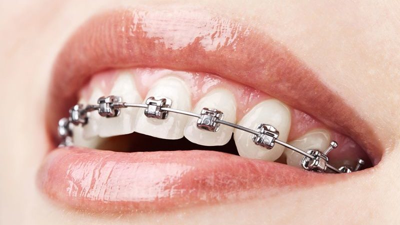 Should You Consider Wearing Retainers After Orthodontic Treatment?