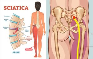 Daily Habits That Cause Sciatica