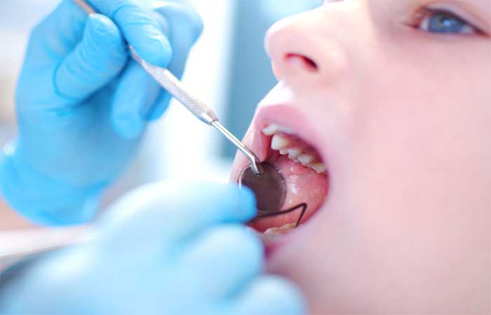 4 Dental Care Tips after Wearing Braces