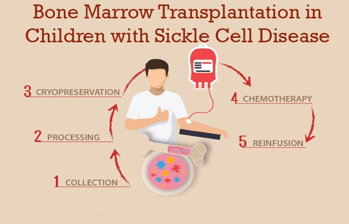Bone Marrow Transplantation in Children with Sickle Cell Disease