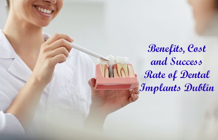 Benefits, Cost and Success Rate of Dental Implants Dublin