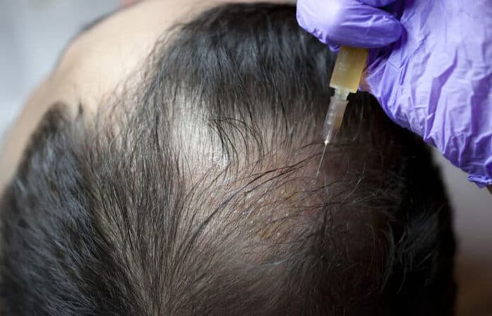 PRP Hair Treatment- Best Solution For Hair Fall