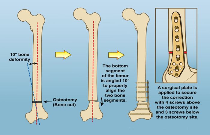 A COMPREHENSIVE STUDY OF ORTHOPEDIC PLATES