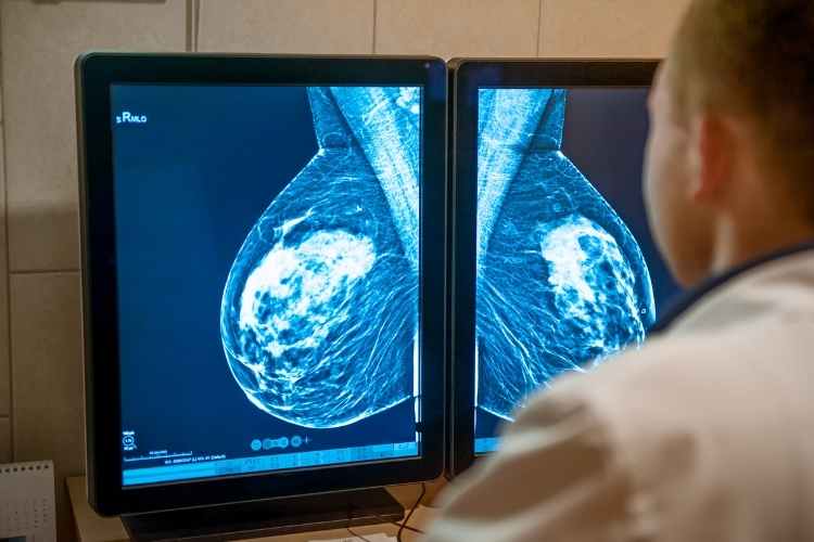 Breast Cancer Tests: Screening, Diagnosis, and Monitoring