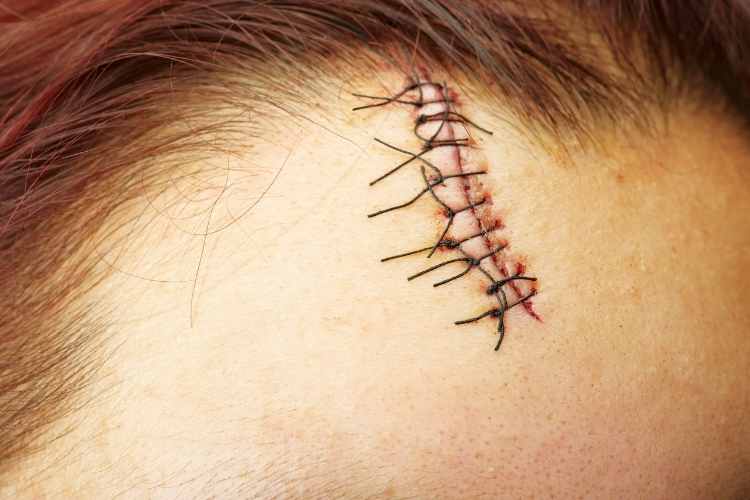 3 Undeniable Signs Your Cut Requires Stitches