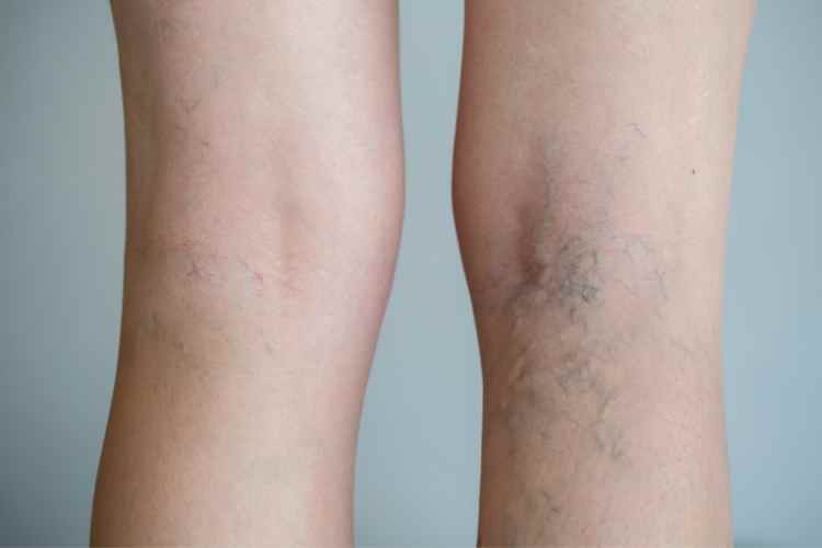 <strong>Tips to Alleviate Varicose Veins Symptoms</strong>