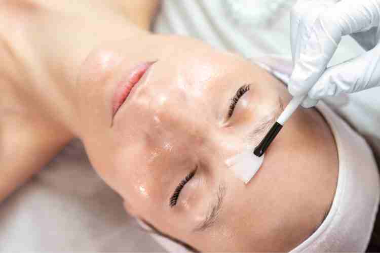 Chemical Peels for Melasma: Restoring Skin Clarity and Evenness